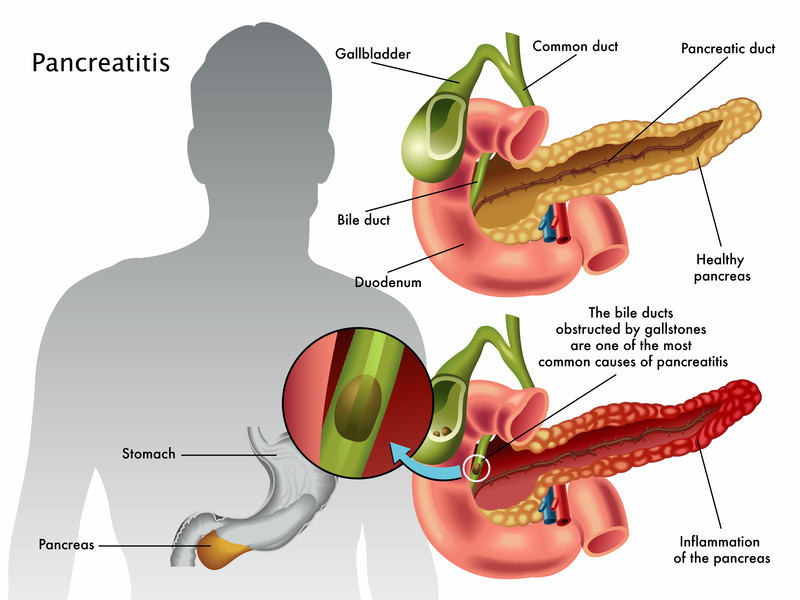 Best gastro surgeon for chronic pancreatitis Vadodara